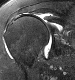 MRI Supraspinatous Retracted to Glenoid Margin